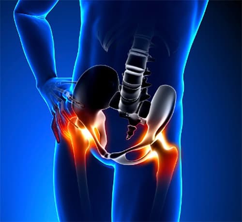 تزریق استروئید در مفصل لگن (ساکروایلیاک)