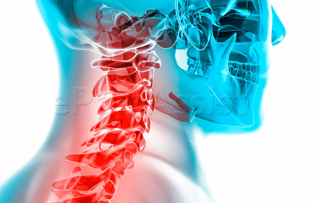 خدمات فوق تخصصی کلینیکهای اینترونشنال درد در درمان دردهای ناحیه گردن